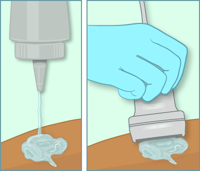closeUp_ultrasound_illustration closeUp_ultrasound_illustration