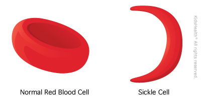 sickle cell sickle cell