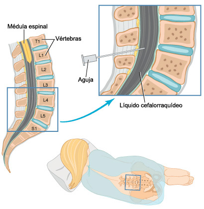 puncion lumbar puncion lumbar