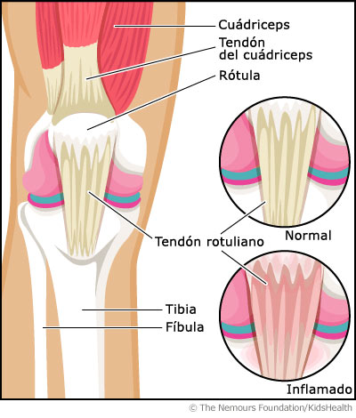 La rodilla de saltador La rodilla de saltador