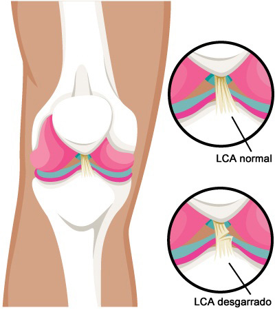 Lesiones del ligamento cruzado anterior (LCA)1 Lesiones del ligamento cruzado anterior (LCA)