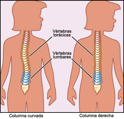 Radiografia escoliosis Radiografia escoliosis