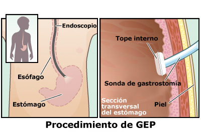 sonda de gastrostomia1 sonda de gastrostomia