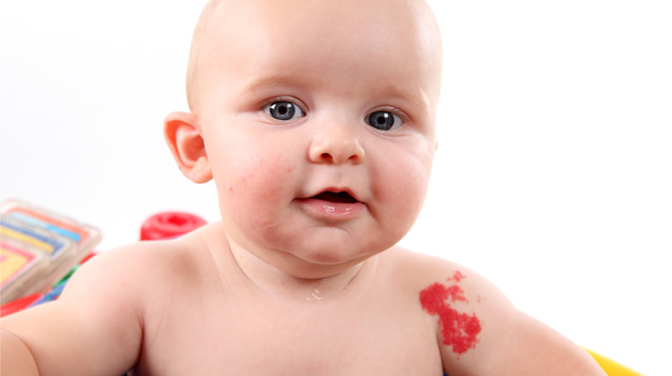 blue eyed baby with red birthmark on shoulder