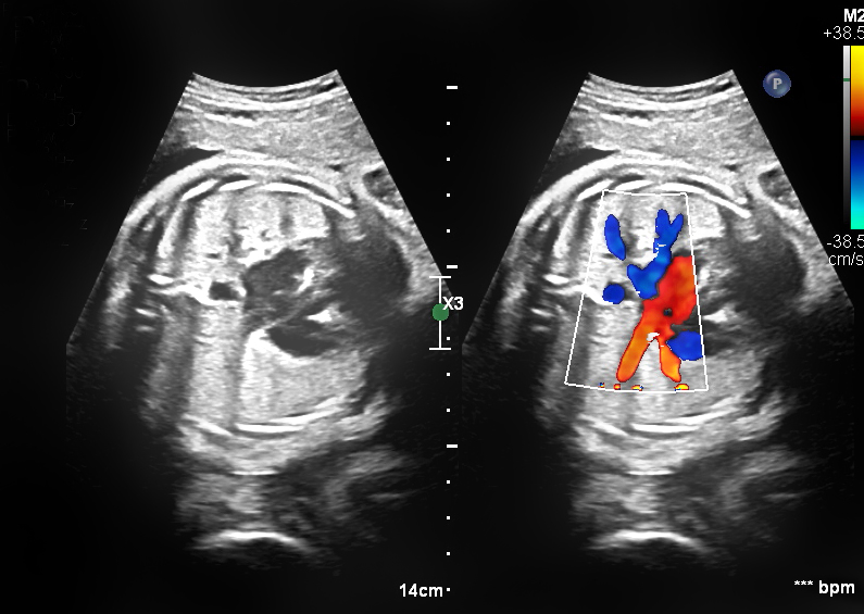 echo 3 heart test Cardiology: Nicklaus Children's  Center Heart Pediatric