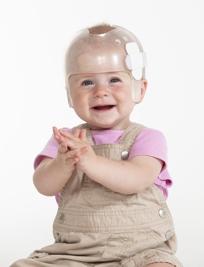 Baby girl wearing a cranial remodeling helmet