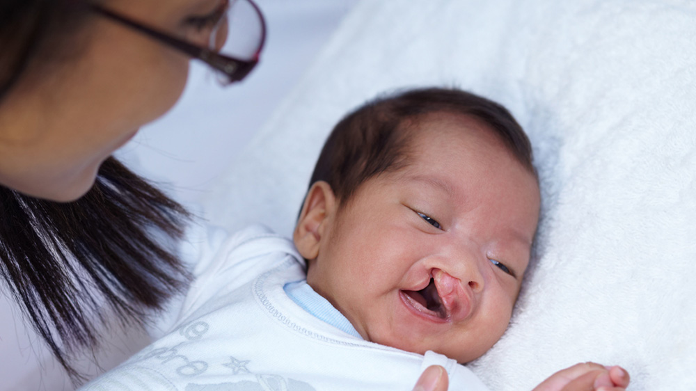 baby with cleft lip palate