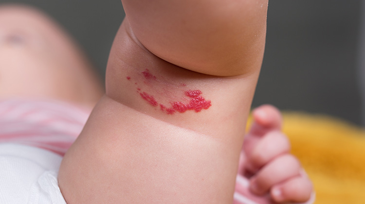 birthmark on baby's leg