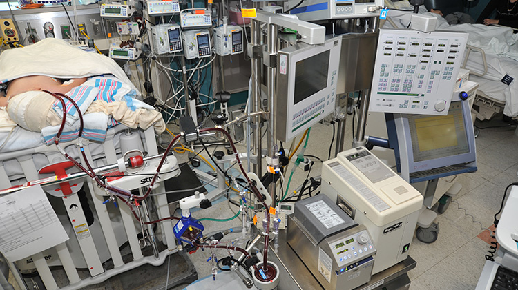 patient connected to ECMO machine