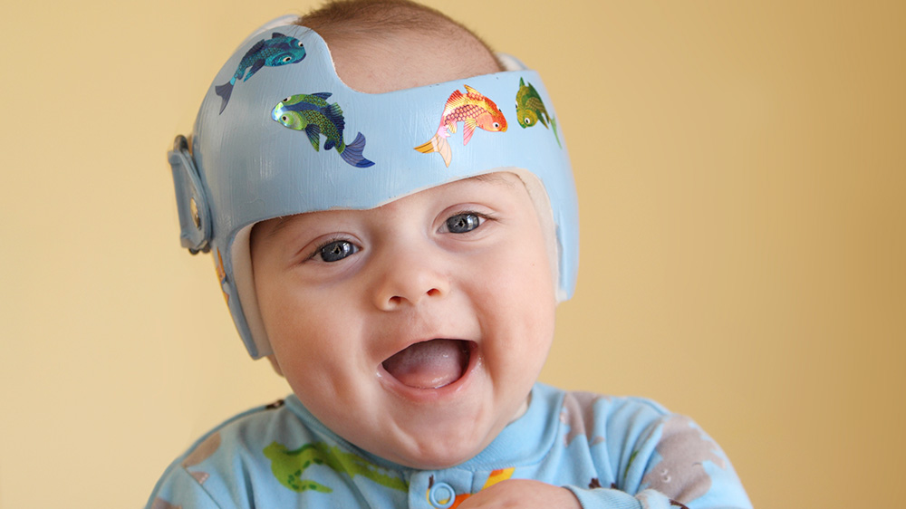 bebé que lleva un casco de remodelación craneal