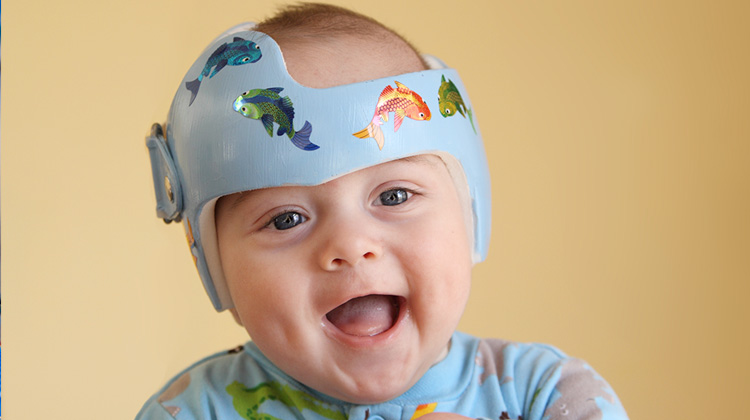 bebé que lleva un casco de remodelación craneal