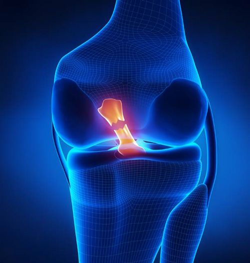 ACL Injury illustration