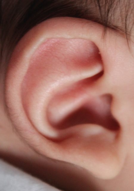Deformidad de oreja del bebé después del tratamiento