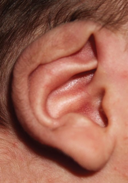 Bebé con deformidad de la oreja