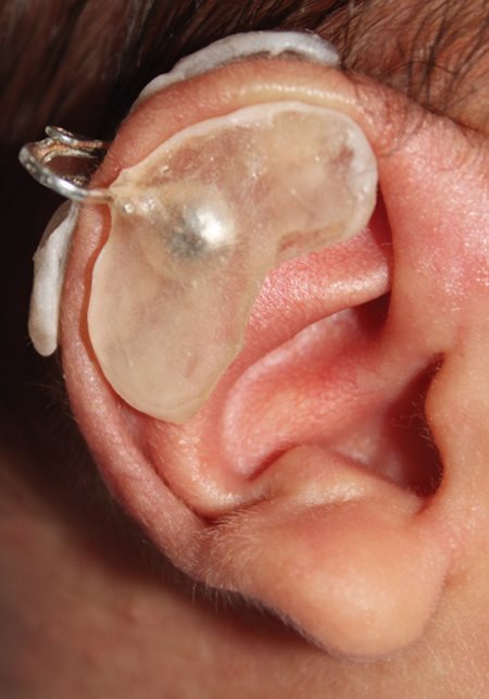 Ear molding treatment
