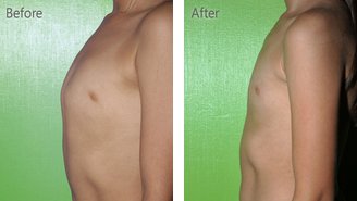 Paciente con pectus carinatum antes y después de la terapia