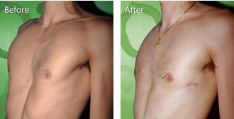 Teenage patient with pectus excavatum after surgery