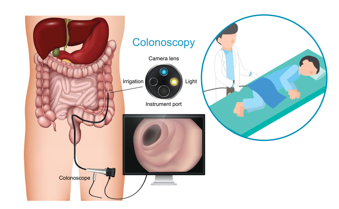 illustration of colon, colonoscope and colonoscopy procedure.