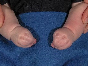 manos con sindactilia (fusión de los dedos)