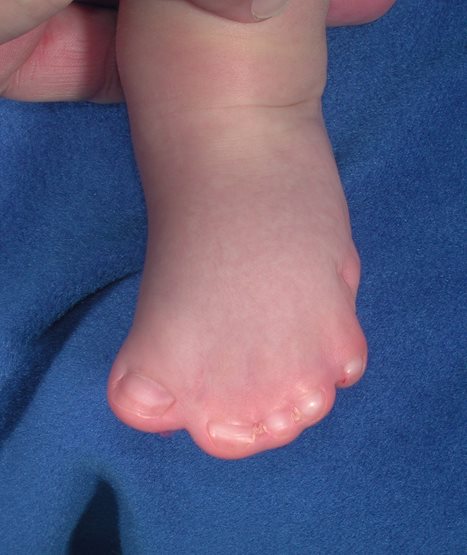 child's foot with syndactyly (fused toes)