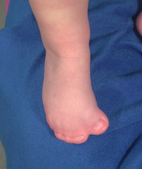 child's foot with syndactyly (fused toes)