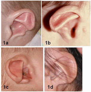 deformidades de las orejas con sindrome charge