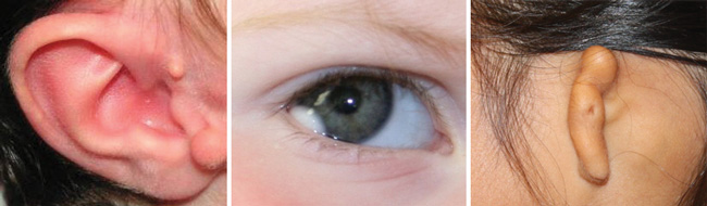 deformities in the ears and eye caused by OAVS