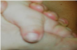 broad thumbs characteristic of pfeiffer syndrome