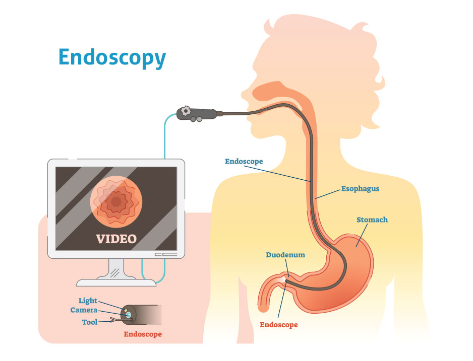 illustration of stomach and endoscope, endoscopy procedure.