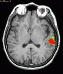 Transverse fMRI image