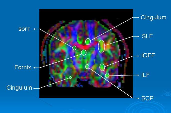 brain scan with lit up areas