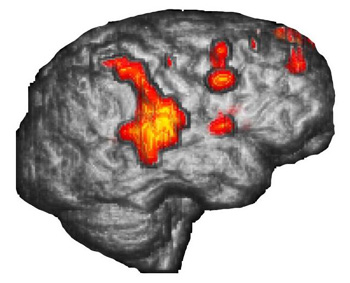 Right hemisphere in 3D-surface rendition