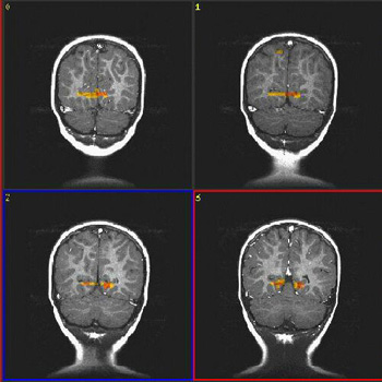 brain scan