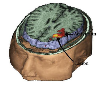 Triple Rendering: MRI (T1), MRI-FLAIR, and fMRI. Left-rostral-top view.