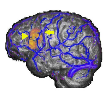 Triple rendering Image. Left lateral view of MRI, MRV and fMRI