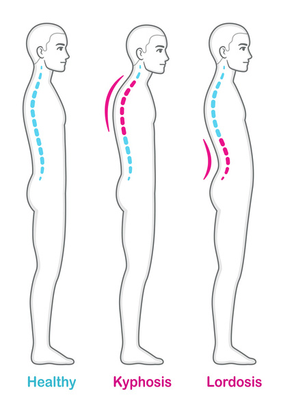Ilustración que compara una columna vertebral sana con  lordosis y cifosis.