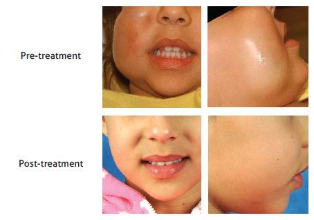 child with Vascular Malformations on cheek Before and After