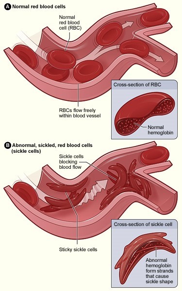 illustration of normal red cells compared to sickle cells