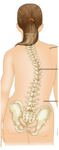 medical illustration of a your woman with curved spine.