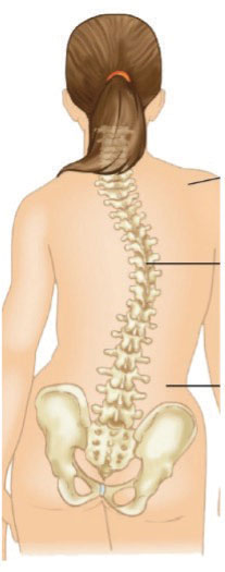 Ilustración médica de una joven con curvatura en la columna.