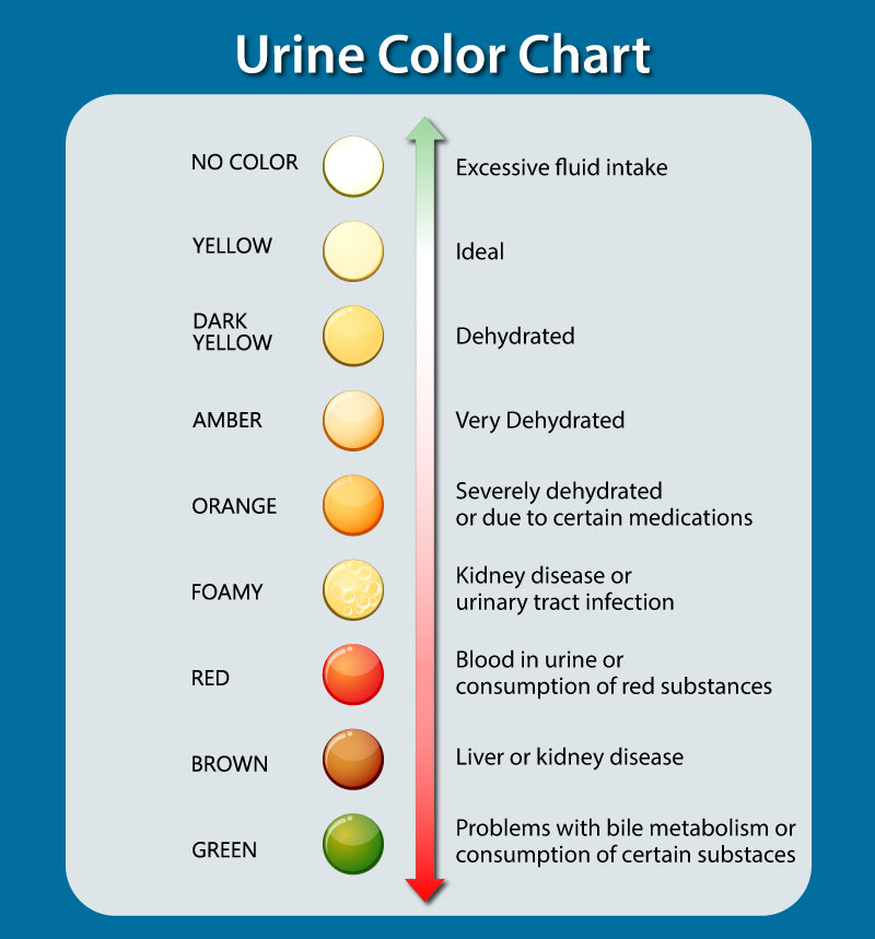 Tabla que explica los diferentes colores de la orina.