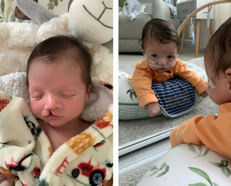 baby Samuel post-surgery.