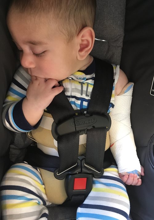 El bebé Emet en su asiento para autos usando un aparato para el cuerpo y brazo