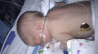 Sebastian at the hospital with feeding tube