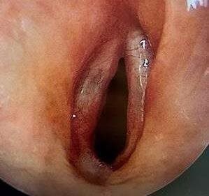 Leonardo's vocal cords after surgery