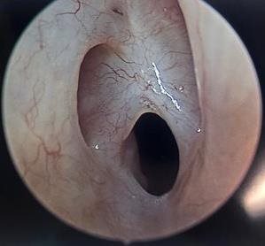 Leonardo's vocal cords before surgery