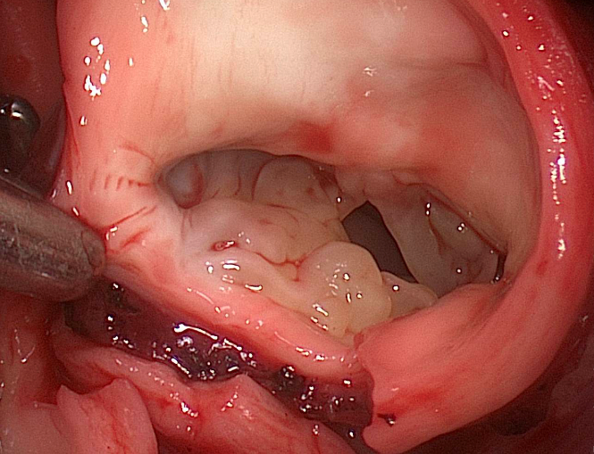 Válvula truncal displásica