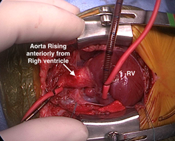 Surgeon’s view of D-TGA.