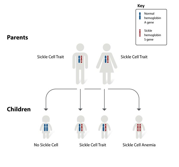 How to diagnose sickle cell disease