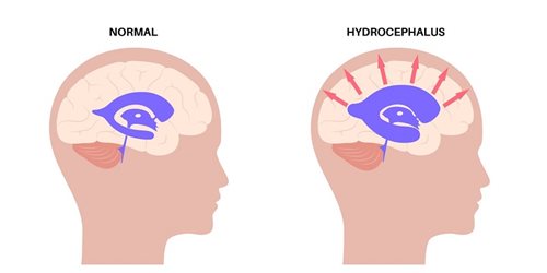 image of normal brain vs one with hydrocephalus